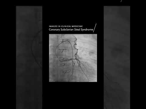 Images in Clinical Medicine: Coronary Subclavian Steal Syndrome